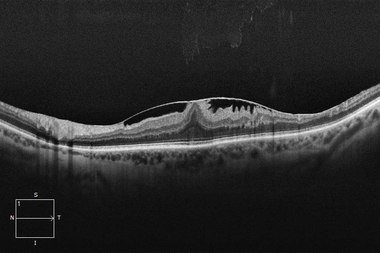Epiretinal Membrane - Queensland Eye & Retina Specialists