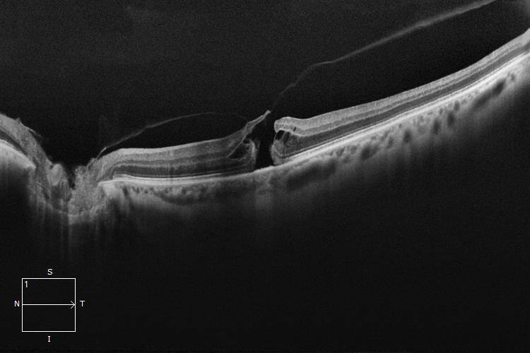 Macular Hole - Queensland Eye & Retina Specialists