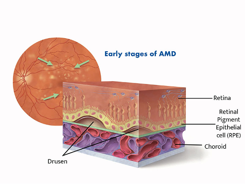 Age-related Macular Degeneration (AMD) | Queensland Eye & Retina Specialists