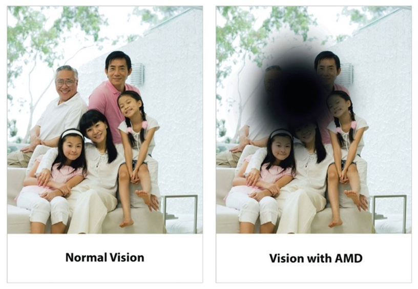 Age-related Macular Degeneration (AMD) | Queensland Eye & Retina Specialists