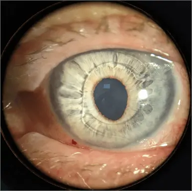 Anterior chamber IOL | QERS