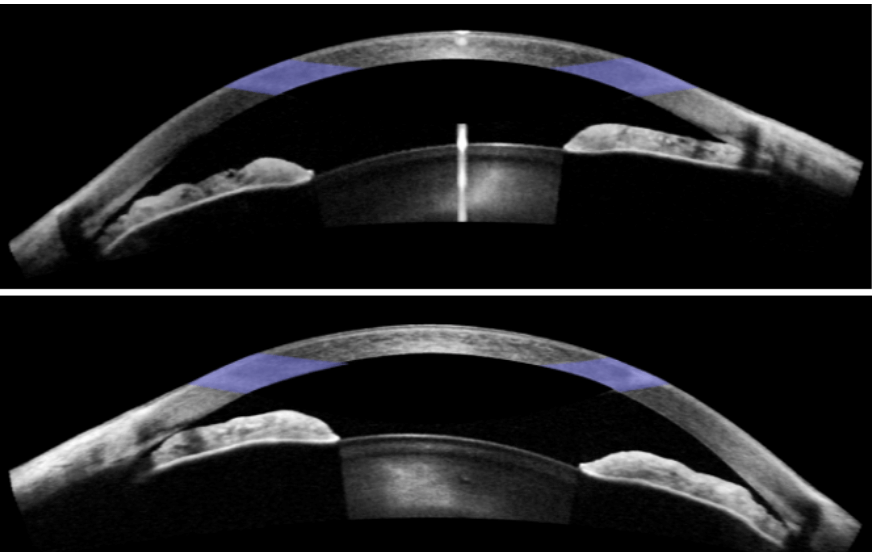 Figure 1: Anterior chamber OCT imaging for RE (top) and LE (bottom).