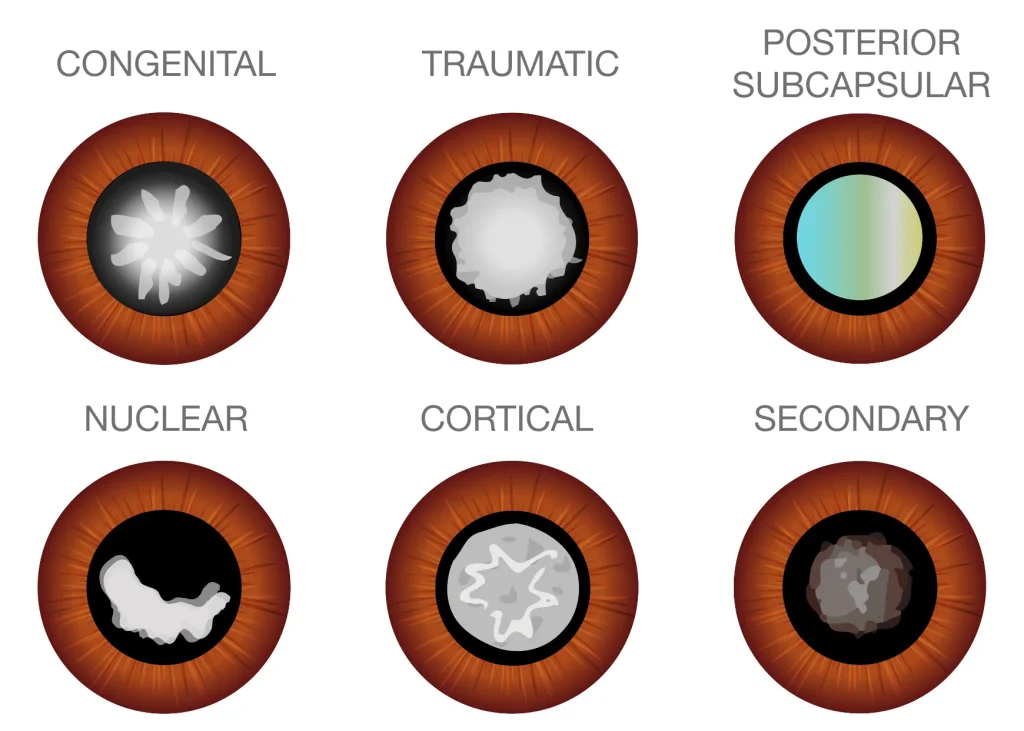 Cataracts 101 | Queensland Eye and Retina Specialist