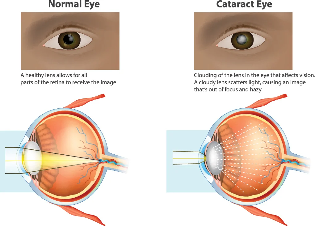 Cataracts 101 | Queensland Eye and Retina Specialist