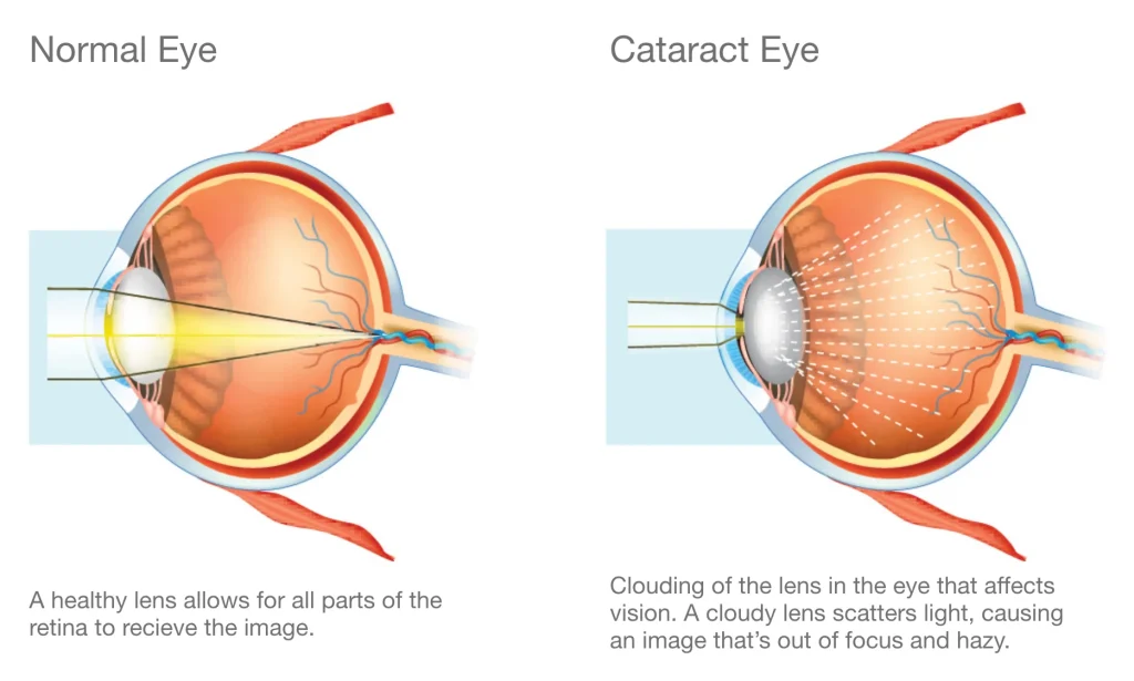 Cataracts 101 | Queensland Eye and Retina Specialist