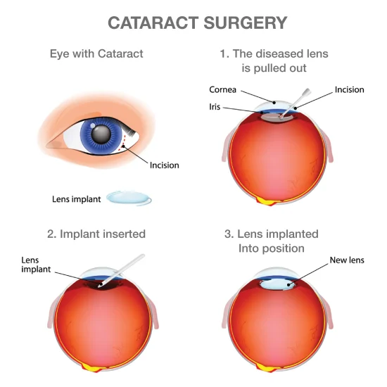 Cataracts 101 | Queensland Eye and Retina Specialist